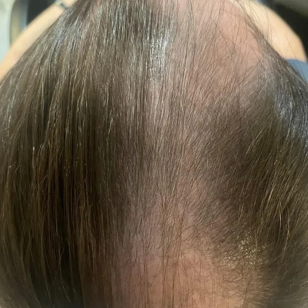 Stan włosów po regularnej pielęgnacji Colostrum Active, łysienie androgenowe u kobiet