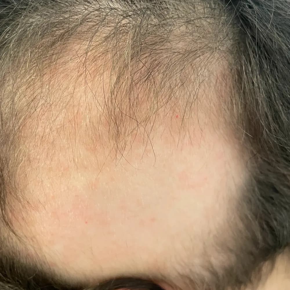 Stan włosów przed regularną pielęgnacją Colostrum Active, łysienie plackowate (alopecia areata)