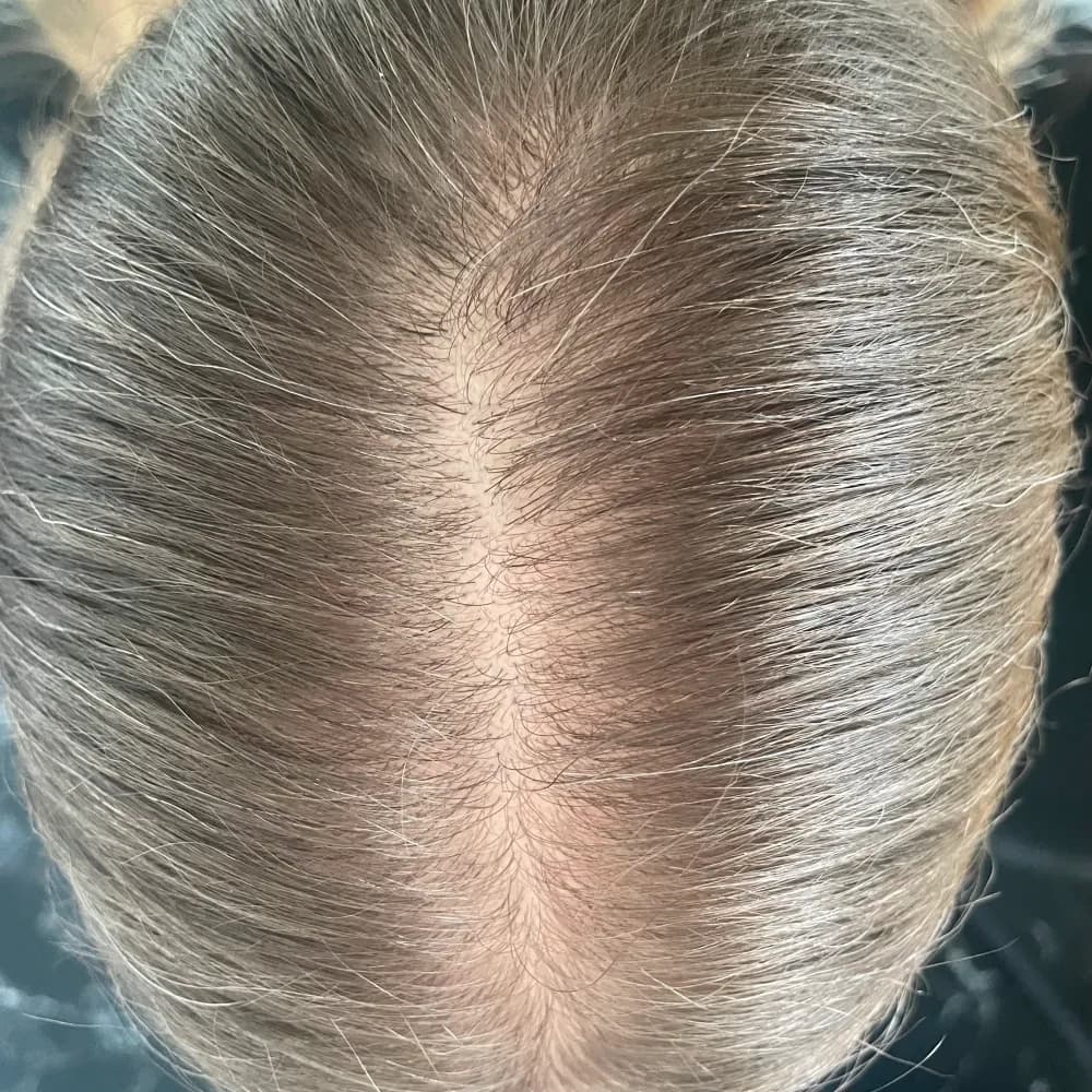 Stan włosów po regularnej pielęgnacji Colostrum Active, łysienie telogenowe (po porodzie, po stresie)